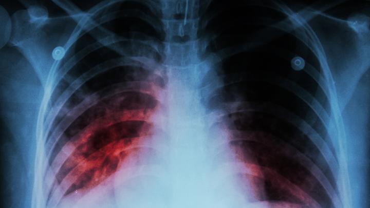 Kementerian Kesehatan Detekesi 700 Ribu Kasus Tuberkulosis pada 2022