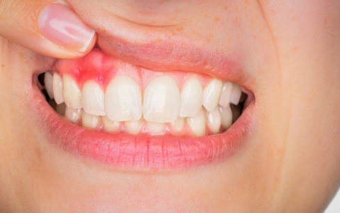 Pentingnya Obat untuk Gusi Bengkak Akibat Gigi Berlubang